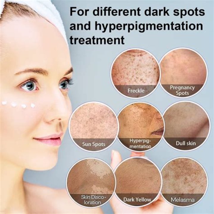 5 Dermatologist-Approved Hyperpigmentation Treatments | Well+Good