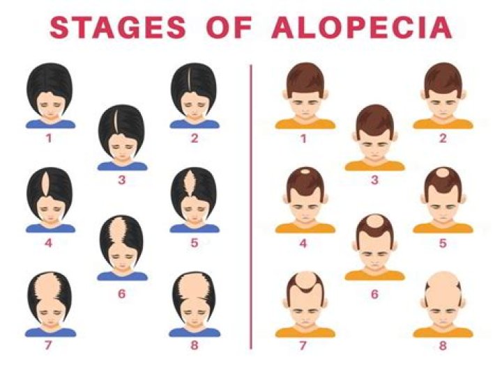 Alopecia Cancer and Hair Loss Update Archives