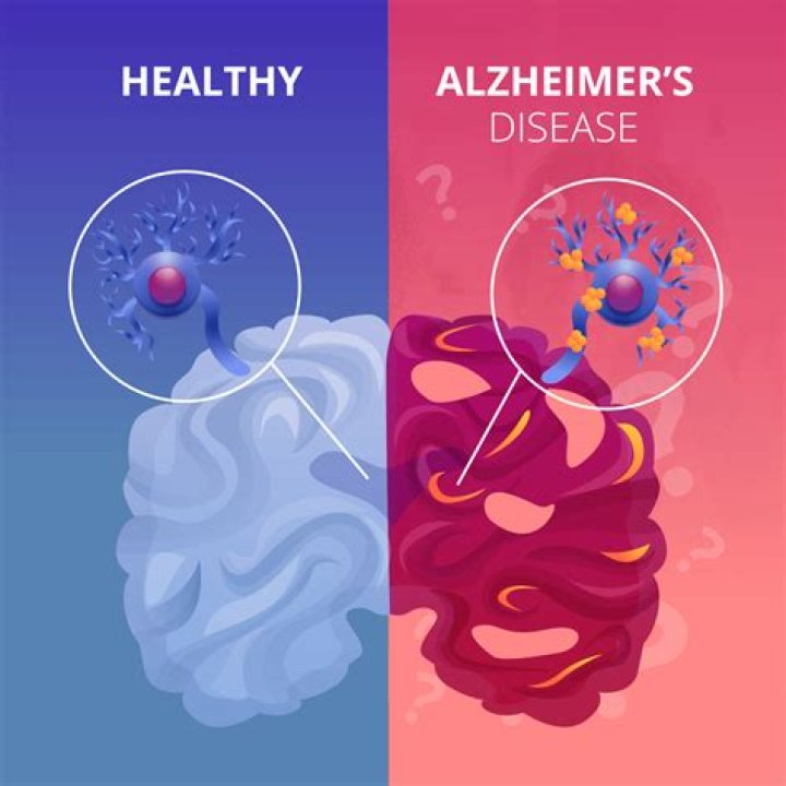Alzheimer's Disease Archives - 247 News Around The World