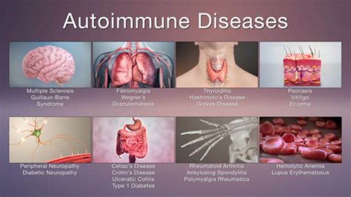 Autoimmune Diseases Archives - 247 News Around The World