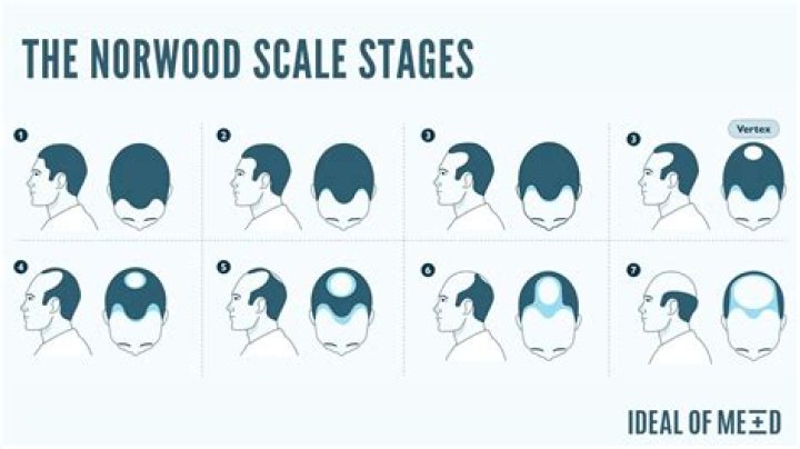 Baldness Details Explained Archives - 247 News Around The World