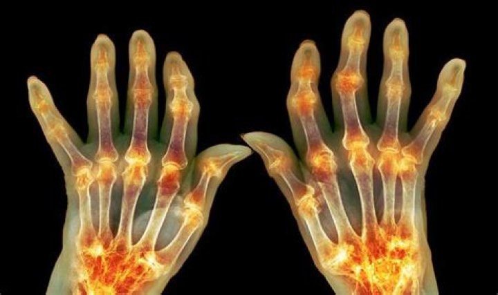 Barry Gibb health: Star recalls 'agony' of condition that affects his whole body