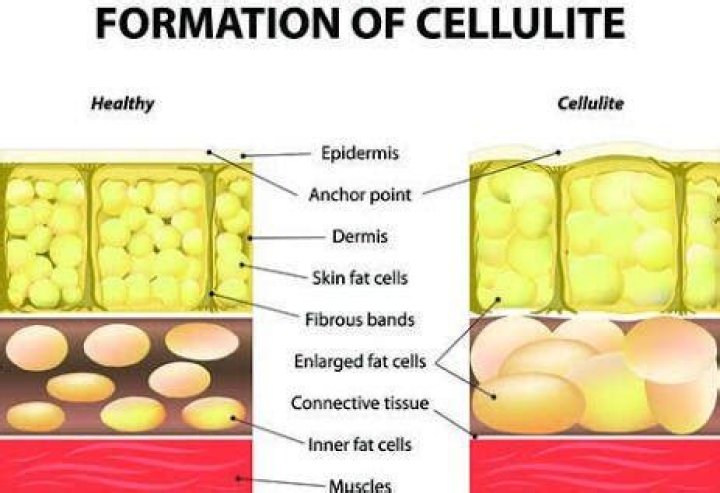 best methods for decreasing cellulite Archives