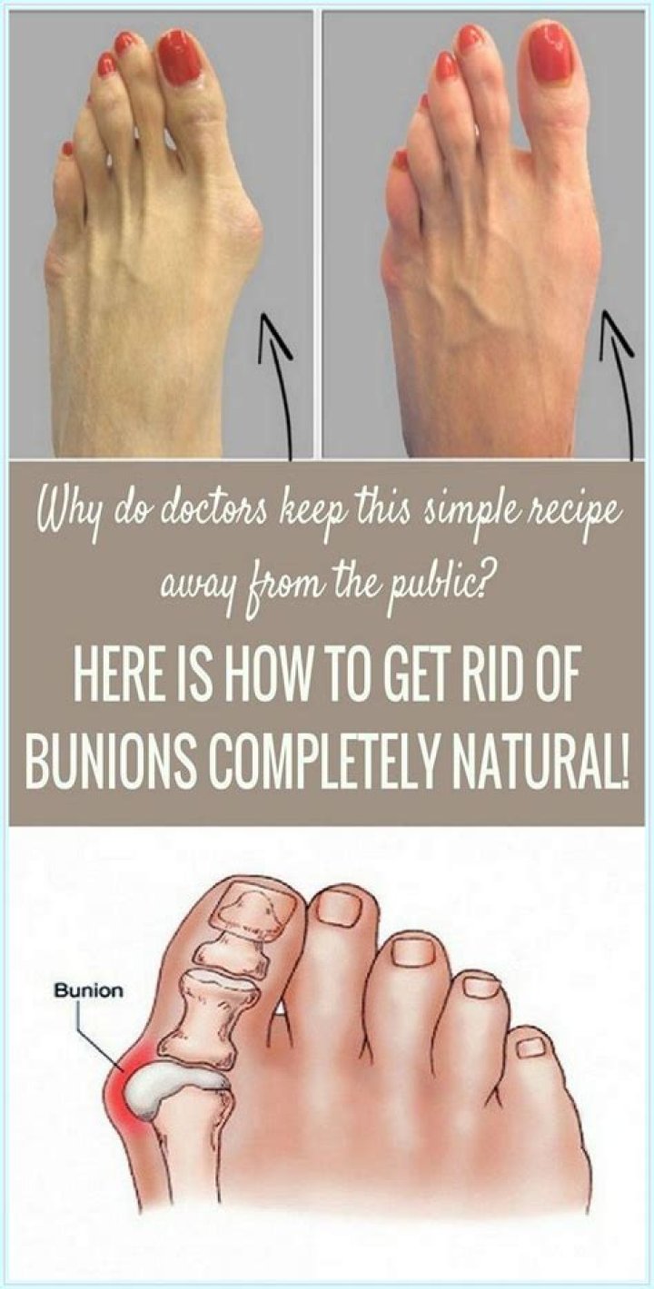 bunions home remedy Archives - 247 News Around The World