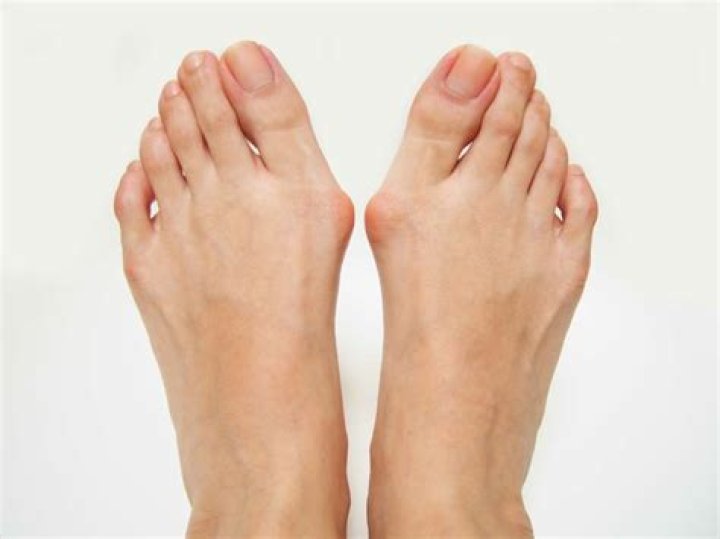 bunions Archives - 247 News Around The World