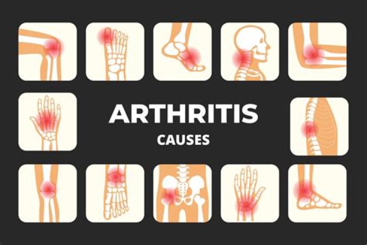 Causes arthritis Archives - 247 News Around The World