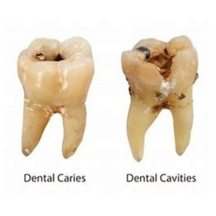 cavities Archives - 247 News Around The World