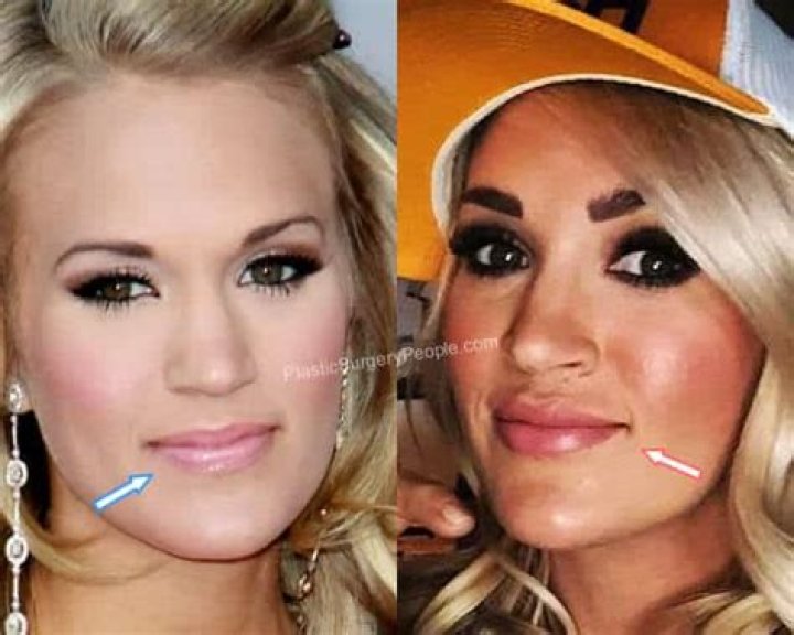 Fact Check: Did Carrie Underwood Get Her Lips Done? Plastic Surgery Before And After