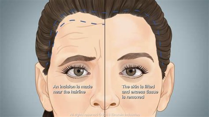 Did Courtney Love Do Nose Job Chin Reduction And Eyebrow Lift? Plastic Surgery Explained