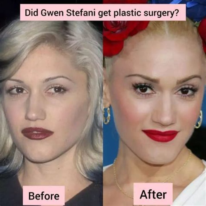 Did Gwen Stefani Undergo Plastic Surgery? Explore Her Before And After Photos Fact Check