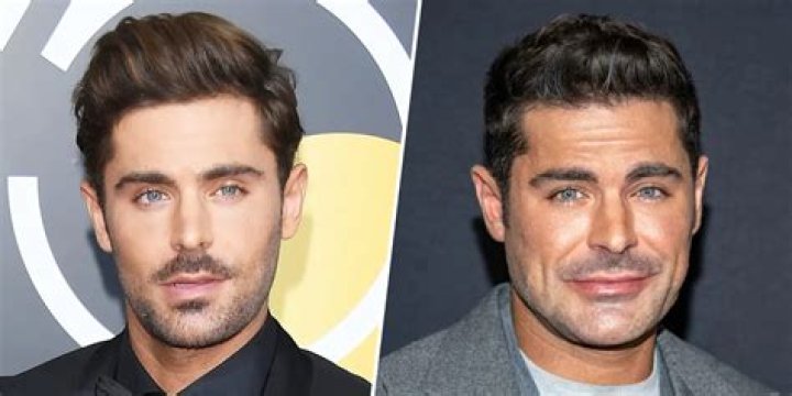 Did Zac Efron Have A Plastic Surgery? Face Accident, Before And After