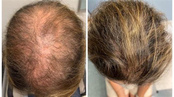 Does Kim Schraub Have Hair Loss: Why Is Skims Creative Director Appears Bald? Illness And Health Update Explained