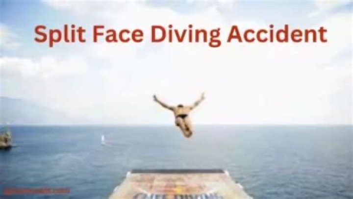 Face Split Diving Accident Twitter Video: How Did It Happen? Boy face split while Diving