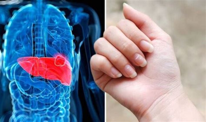 Fatty liver disease: The ‘lesser-known’ signs include finger clubbing - ‘See your GP’