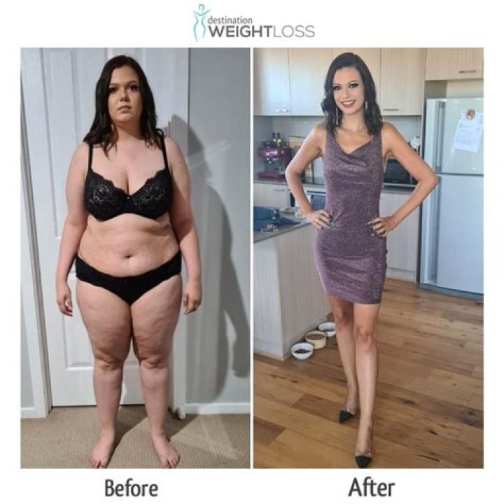 Gastric bypass side effects: Woman, 32, reveals her teeth FELL OUT due to low vitamin levels