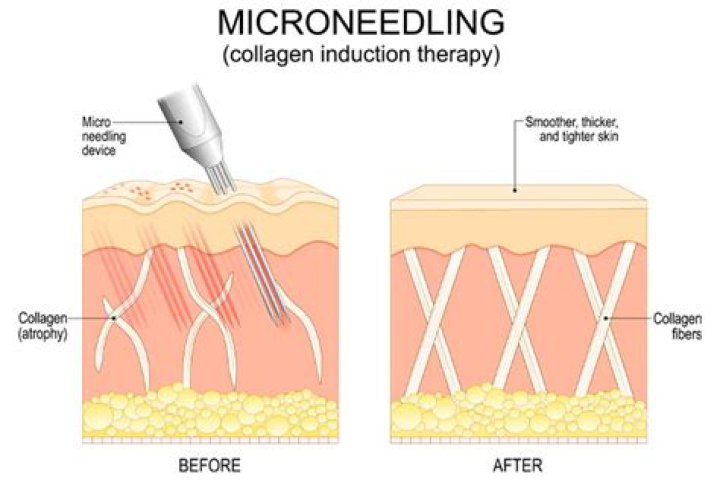 How Can Microneedling Help with Hyperpigmentation? – Credihealth Blog