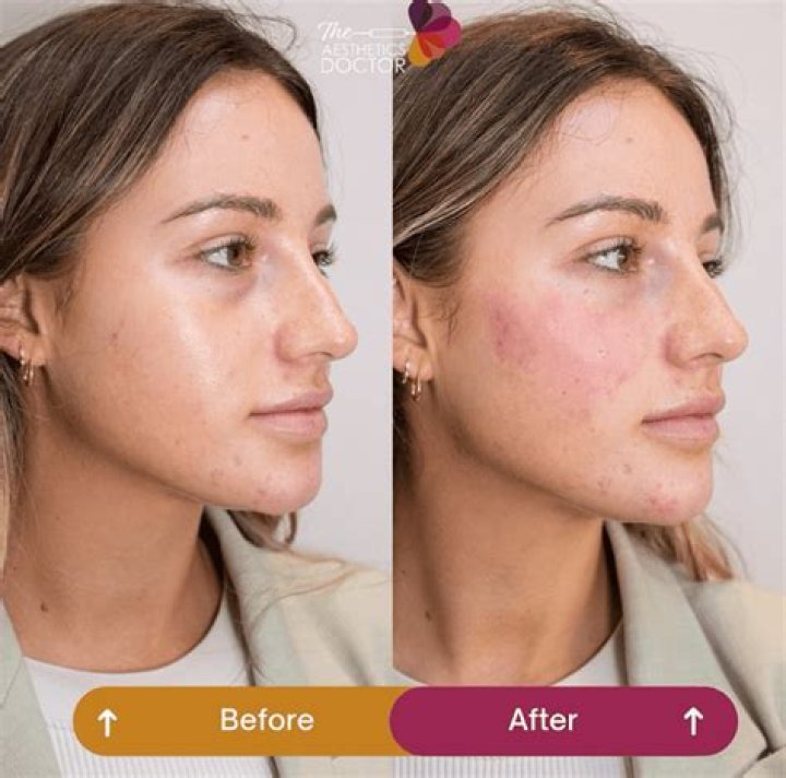 How To Prevent Lip Filler Migration