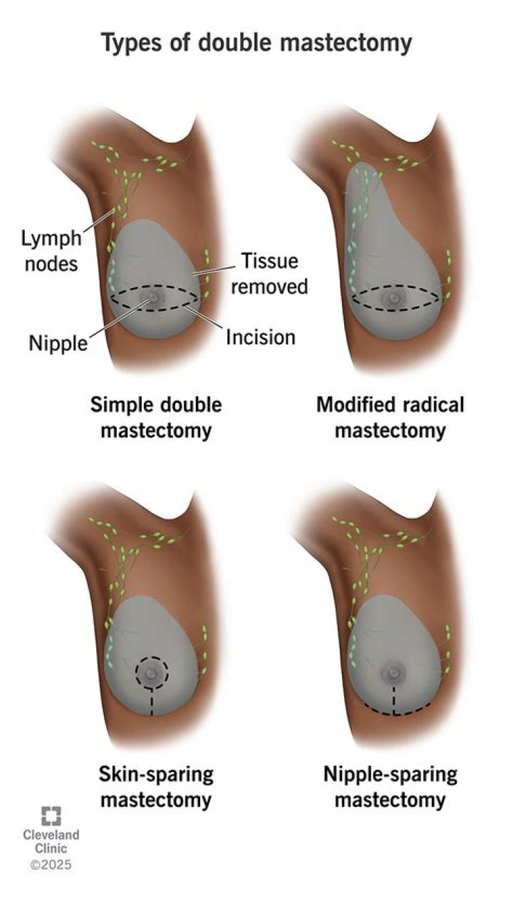 I had a double mastectomy to remove my boobs -and I feel more confident than ever