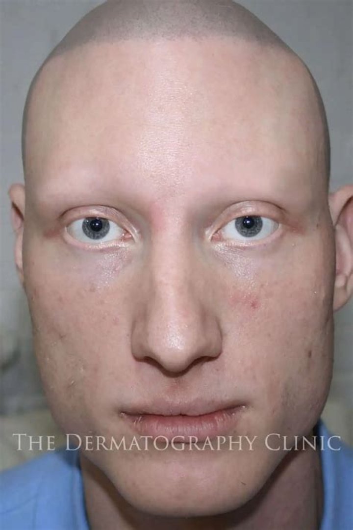 I'm A Celebrity star Shaun Ryder left with no eyelashes due to alopecia