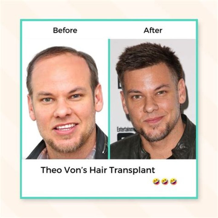 Is Theo Von Doing Hair Transplant? Comedian Hair Loss Facts And Treatment Details Here