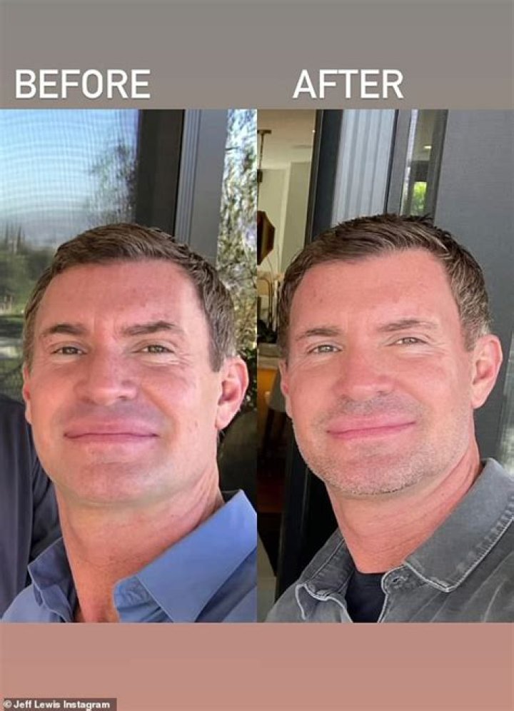 Jeff Lewis shares before and after photos following fat repositioning surgery on his eyes