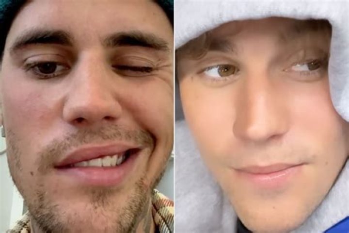 Justin Bieber health: Star shares his Ramsay Hunt syndrome symptoms