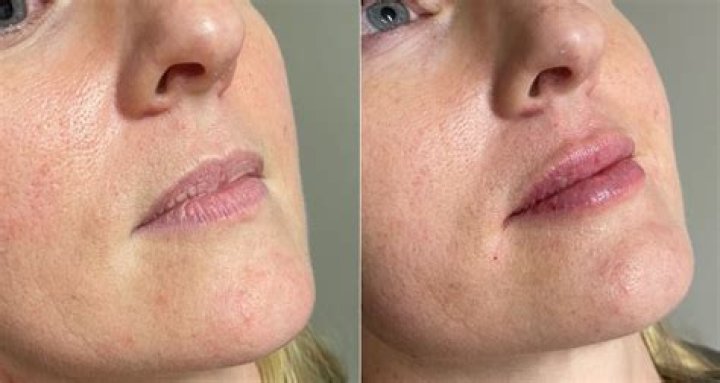 Katie Price reveals her plump new lips as she gets filler injected after ditching Botox