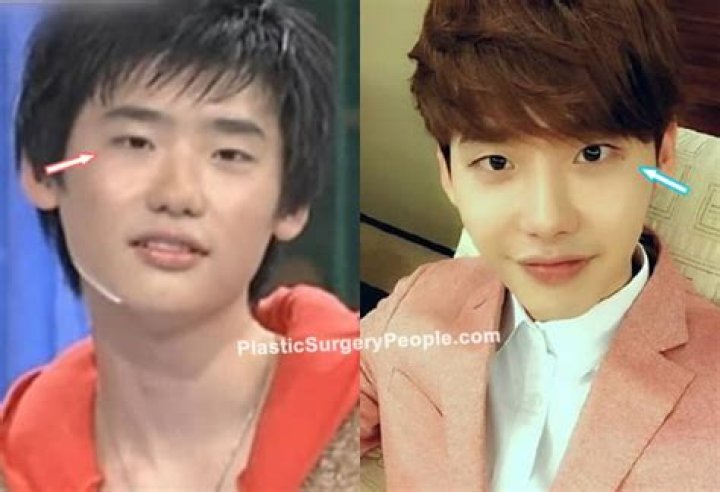 Lee Jong Suk Before Plastic Surgery: What Is Wrong With His Face? His Net Worth 2023