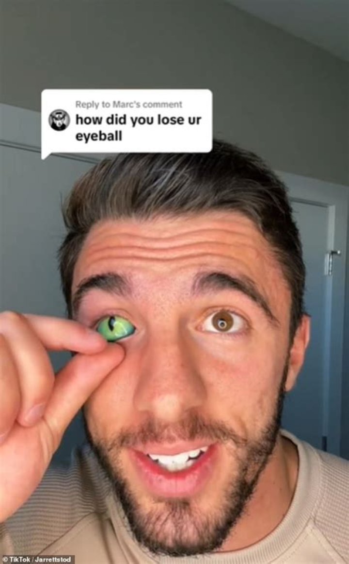 Man who lost his eye when he was two years old says his mom sparked concern when she spotted 'golden' glint in photo