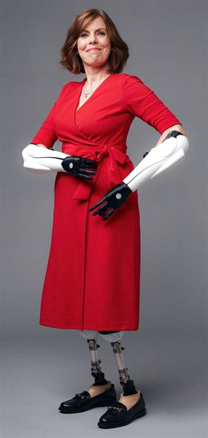 Mother who lost all four limbs to sepsis returns to her teaching job