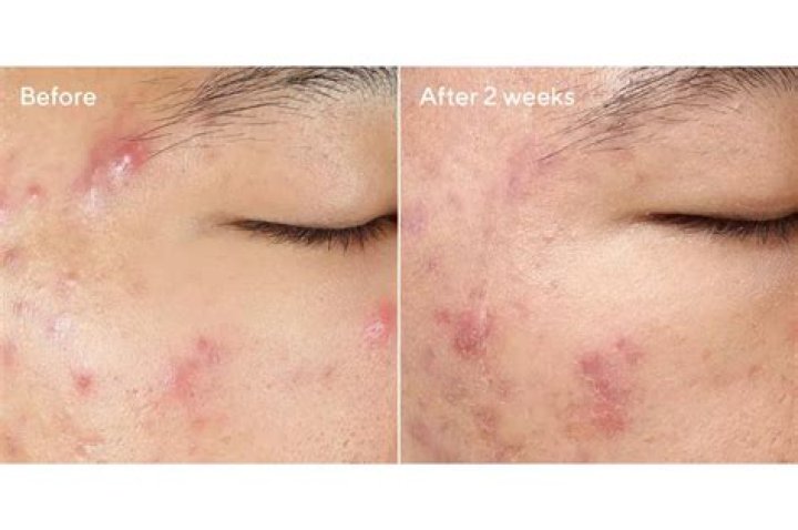 Murad Deep Relief Acne Treatment Before and After