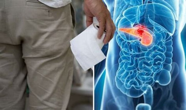 Pancreatic cancer: Symptoms include light-coloured and greasy poo