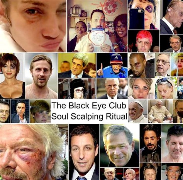 Roland Gutierrez Black Left Eye - What Happened To Him? His ForeHead Injury: How Did It Happen? Explored