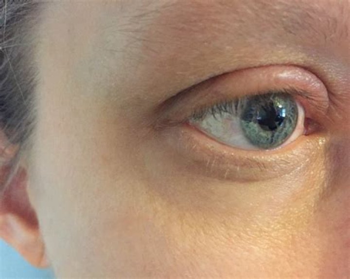 Swollen Eyelid: Causes, Symptoms, and Treatment