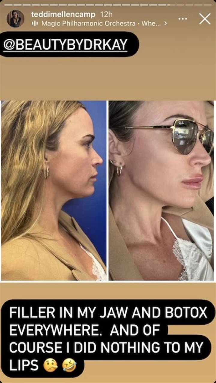 Teddi Mellencamp Shares Before and After Filler, Botox Pics