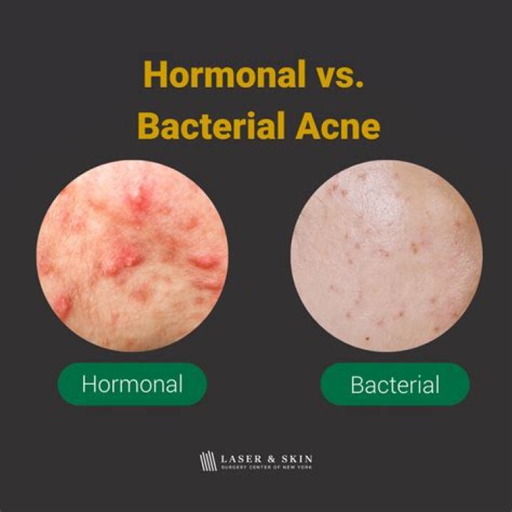The Difference Between Hormonal Acne And Bacterial Acne