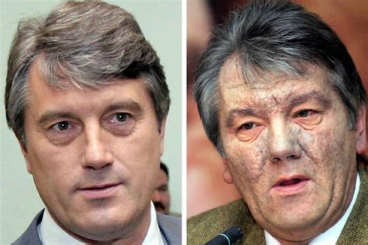 Viktor Yushchenko Face Before And After, Former President Was Poisoned By An Agent