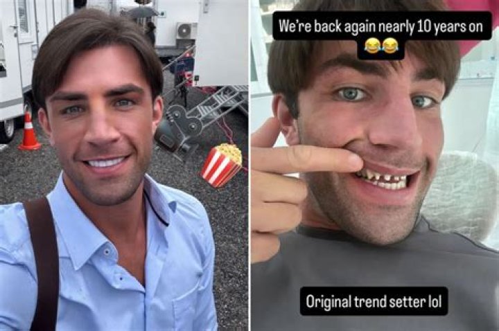 What Happened To Love Island Jack Fincham Teeth? Before & After Photos - Has He Whitened Them, They Are Glowing!￼