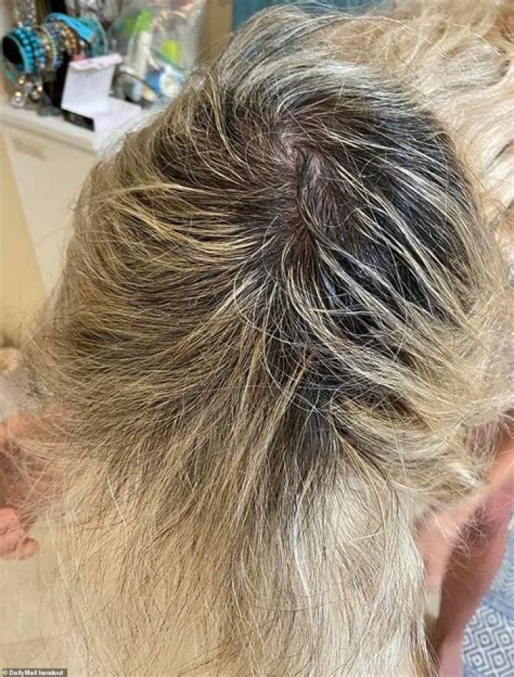 Women who suffered hair loss after a bout with COVID-19 describe how it hurt their self-esteem