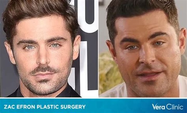 Zac Efron Plastic Surgery Video: Before & After Photos In 2022 - Has He Gotten Cosmetic Surgery?